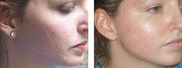 Acne Scar Laser Treatment