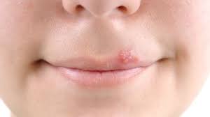 Die viren lagern sich in den nervenenden ein. Lippenherpes Behandlung Verlauf Ursachen Onmeda De