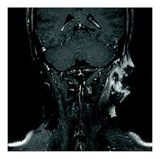 Affection of facial muscles and internal organs. (a) MR of the neck...