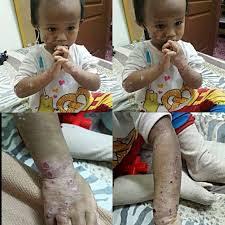 Serta obat alami yang aman untuk diberikan pada bayi & balita, untuk mengatasi masalah kulit tersebut. Bayi Susu Formula Untuk Bayi Eczema
