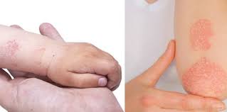 Penyebabnya karena kulit kekurangan kelembabannya yang diakibatkan oleh terpapar udara. Kulit Mengelupas Ini 8 Penyebab Dan Tips Mengatasinya Dari Dokter