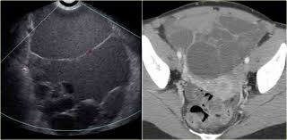 Ovarian Cysts Common Lesions Ovarian Cyst Ovarian Avascular