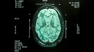 There are dozens of parkinson's disease symptoms, and they vary by individual. The History Of Parkinson S Disease Everyday Health