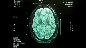 Tremors are common, but the disorder also commonly causes stiffness or slowing of movement. The History Of Parkinson S Disease Everyday Health