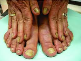 Image result for Yellow nail syndrome feet