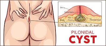 Image result for itchy skin rectum