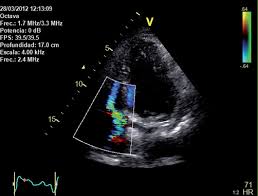 Image result for Cardiac Pacemaker Infection