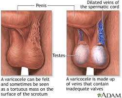 A varicocele is an enlargement of the veins within the scrotum, similar to varicose veins in the legs. It occurs when the valves in the spermatic cord veins fail to function properly, causing blood to pool and veins to dilate. Varicoceles are common, especially during puberty, and can lead to discomfort and fertility issues. Below is a detailed overview of its causes, symptoms, diagnosis, and treatment options.
