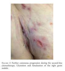 Image result for Vulvar Cancer