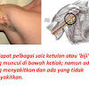 Kanker payudara adalah sel kanker yang berkembang dari jaringan payudara. 1