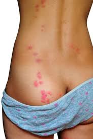 Image result for bedbugs bites