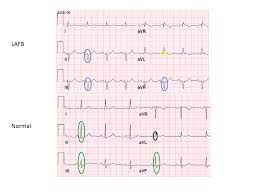 Just finished a gym session along with my brother at about 9 pm. Routine Ekg Finding Could Signal Serious Heart Problem