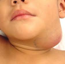 Image result for phlegmon on face)