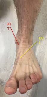 Maybe you would like to learn more about one of these? Tibialis Posterior And Anterior Tendons Musculoskeletal Key
