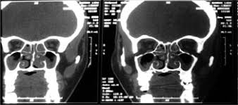 Mucormycosis (previously called zygomycosis) is a serious but rare fungal infection caused by a group of molds called mucormycetes. Mucormicosis Rinosinusal En Un Paciente Infectado Por Vih