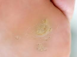But dead skin from the foot is visibly black and painful. Plantar Callus Symptoms Causes And How To Remove Them