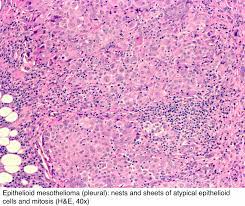 Check spelling or type a new query. Pathology Outlines Mesothelioma Peritoneum Epithelioid