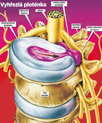 Image result for vyhřezlá ploténka