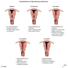 Cervix position during conception and early pregnancy. Spontaneous Abortion Obstetrics Medbullets Step 2 3