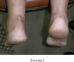 Pdf Could Ossification Of The Achilles Tendon Have A Hereditary Component Semantic Scholar
