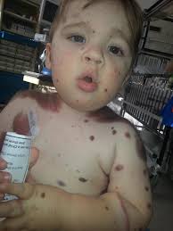 Hi everyone let me introduce you to Dylan.... Dylan was born with a rare  condition called Giant Congenital Melanocytic Nevus, it effects 1/500,000  and of those, 1% also has it in their