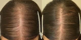 Topical finasteride results of hair loss treatment are as good as oral, but with fewer side effects. Finasteride Females Before After Photos Hair Restoration Of The South New Orleans La