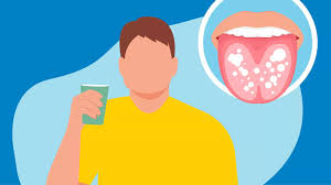 Image result for oral thrush symptoms roof of the mouth