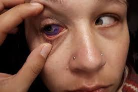 I had a dream where i woke up with a tattoo on my forearm. Sunlive Eyeball Tattoo Warning The Bay S News First