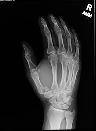 Image result for Hand XRay