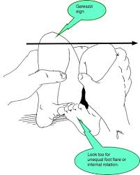 Image result for Galeazzi Sign