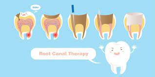 Apr 20, 2021 · when to eat after a root canal most dentists will recommend waiting to eat until your teeth and gums no longer feel numb after the root canal. Eating After Root Canal Therapy Marsfield Dental Care