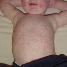 For the case of mottled skin in babies, it happens due to the decline of blood flow to the skin. Skin Rash Causes 68 Pictures Of Symptoms And Treatments