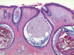 The disease was originally described in 1932 by favre 1. Favre Racouchot Syndrome Pathology Dermnet Nz