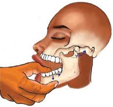 Image result for Jaw Dislocation