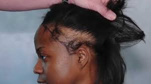 Excellent results can be achieved with black hair. Ethnic Hair Restoration Treatment Dallas L San Antonio