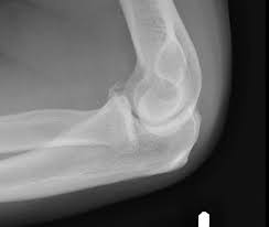 Image result for Coronoid Process Fracture