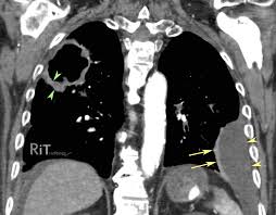 Image result for Lung Abscess