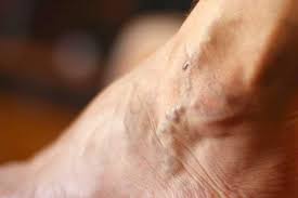 Los trombos superficiales se producen frecuentemente en las venas. Center For Vein Restoration Que Es La Trombosis Venosa Superficial Y Como Se Trata