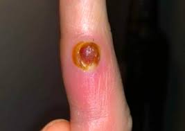 Image result for Pyogenic Granuloma