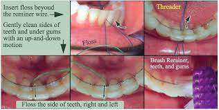 With this video i show you how to floss with and without braces and around a permanent or fixed retainer! Fixed Lingual Retainer Hoboken Orthodontics Hoboken Nj