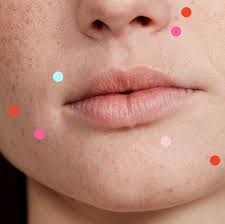Pomade acne is caused by hair products, particularly thick or greasy ones, says kraffert. Why Am I Breaking Out 15 Acne Causes You Need To Know About