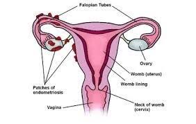 Endometriosis is a painful condition where tissue that is similar (but not identical) to the kind inside endometriosis is classified into one of four stages. Endometriosis Specialist Melbourne Symptoms Treatment A Prof Alex Ades