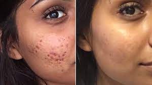 This face wash is reminiscent of a spa day: Controversial Cystic Acne Routine Goes Viral Before And After Photos Allure