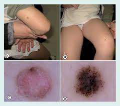Image result for Spitz Nevus