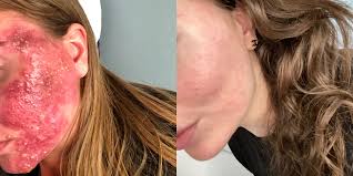 Isotretinoin causes severe birth defects (deformed babies), loss of a baby before birth (miscarriage), death of a baby and early (premature) births. Roaccutane What It S Like To Take The Acne Control Medication