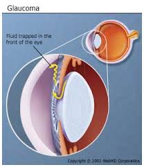 We did not find results for: Diabetic Retinopathy Types Symptoms Prevent Treatment