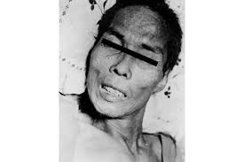 Image result for Tetanus