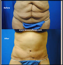 Pin On All About Liposuction