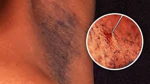 Try to avoid plucking the hair out completely while it's under the. How To Get Rid Of Dark Spots On Armpits Ingrown Hair Treatment Youtube
