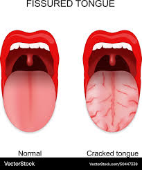 Image result for Fissured tongue